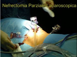 Video "Nefrectomia parziale laparoscopica"